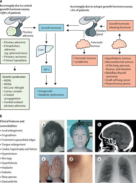 Acromegaly: pathogenesis, diagnosis, and management - The Lancet Diabetes & Endocrinology