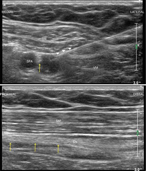 The Adductor Canal Block | Anesthesia Key