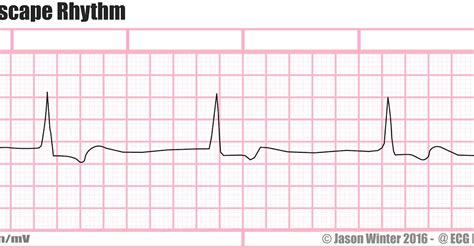 ECG Educator Blog : Junctional Escape Rhythm/Complex