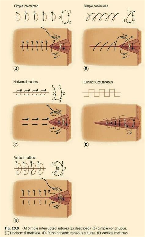 Surgical Sutures | Nurse Practioner | Pinterest | Surgical suture ...