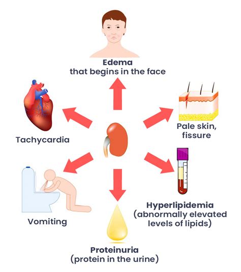 Nephrotic Syndrome - Mind The Bleep