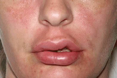 Case Study - Unexplained facial swelling | GPonline