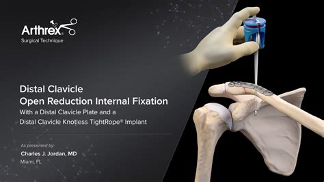 Arthrex - Distal Clavicle Open Reduction Internal Fixation With a Distal Clavicle Plate and a ...