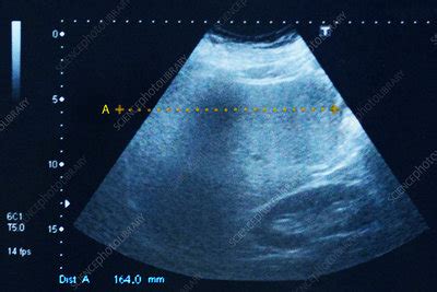 Hepatomegaly ultrasound - Stock Image - C026/9497 - Science Photo Library