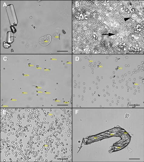 Cells In Urine Sediment / Microscopic examination of urine sediment ...