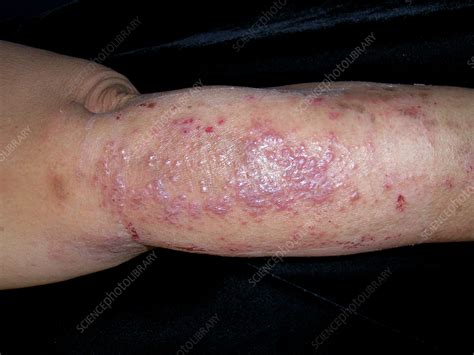 Allergic contact dermatitis - Stock Image - C057/0624 - Science Photo Library