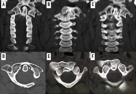 Acute traumatic lateral atlantoaxial dislocation associated with locked atlas lateral mass and ...