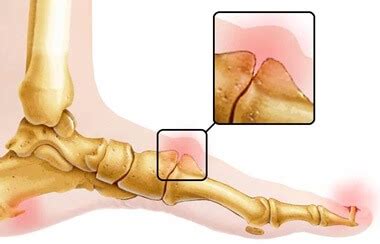 Lump On Top Of Foot: Common Causes & Treatment