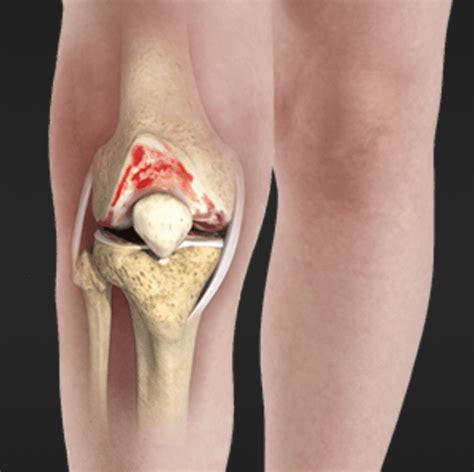 Knee osteoarthritis, a common cause of knee pain: Orthopedic Center for Sports Medicine: Sports ...