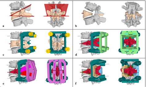 Pedicle subtraction osteotomy with patient-specific instruments - North American Spine Society ...