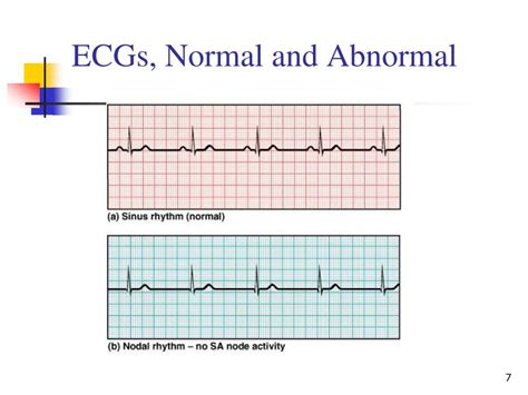 Ppt The Normal And Abnormal Ecg Powerpoint Presentation Free Download ...