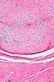 Palmar fibromatosis - Libre Pathology