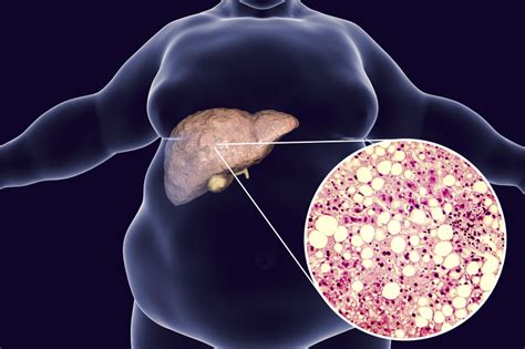 Fatty Liver Cyst - Herbs and Food Recipes