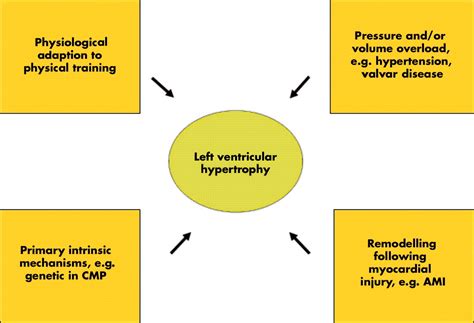 Left ventricular hypertrophy in hypertension: its arrhythmogenic potential | Heart