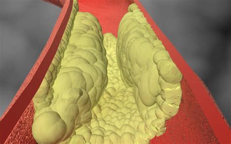 Testing for calcium in the coronary arteries provides better way to predict heart attacks than ...