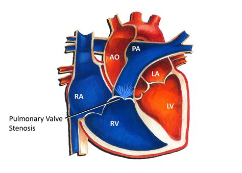 Pulmonary Valve Hypoplasia