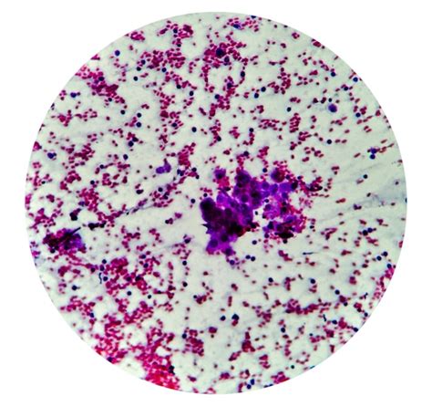 Premium Photo | Spindle cell sarcoma, positive for malignant cells. pleomorphic undifferentiated ...