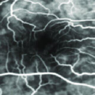 (PDF) Diagnosis and management of serpiginous choroiditis