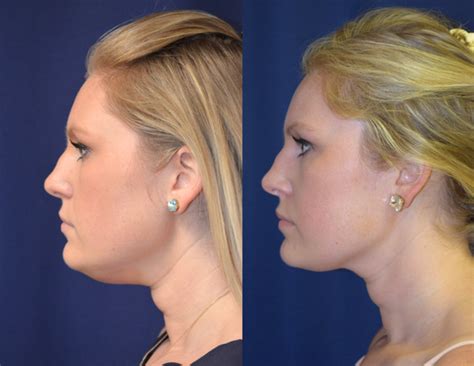 How to Reduce Double Chin: KYBELLA® vs CoolSculpting®