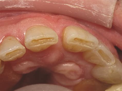 Show Your Work: Treating Incisal Edge Wear by Dr. Marvin Fier - Dentaltown