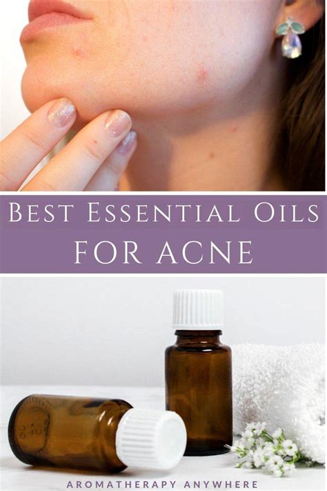 Best Essential Oils To Combat Acne + Anti-Acne Recipes - Aromatherapy Anywhere