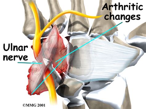 Physical Therapy in our clinic for Hand - Guyon's Canal Syndrome