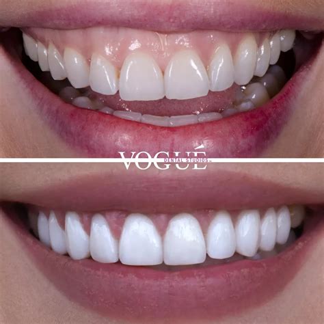 Gum lift before and after – Artofit