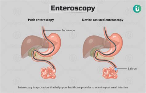 Enteroscopy: Procedure, Purpose, Results, Cost, Price, Online booking