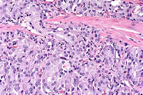 Carcinoma, Islet Cell; Islet Cell Tumor, Malignant