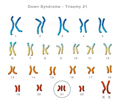 Down syndrome Karyotype | Stock Image - Science Source Images