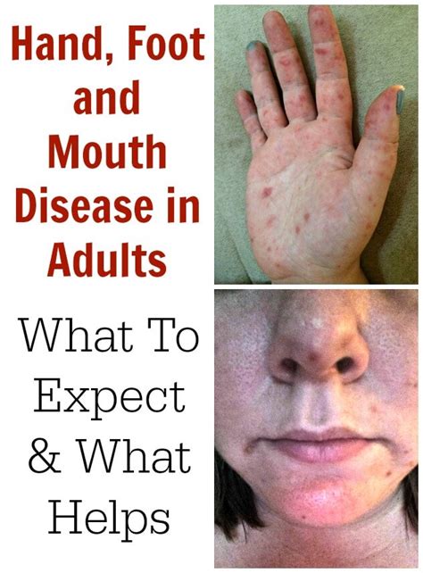 Hand, Foot and Mouth Disease in Adults – What To Expect | TOTS Family, Parenting, Kids, Food ...