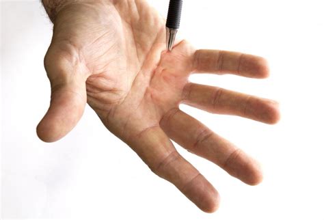 Dupuytren's contracture: Symptoms, causes, and risk factors