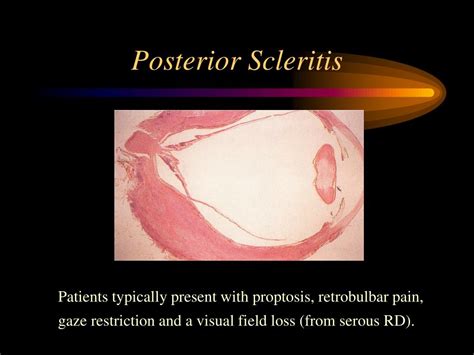 PPT - Scleritis Diagnosis & Management PowerPoint Presentation - ID:5542222