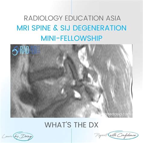 PARS DEFECT RADIOLOGY MRI - Radedasia