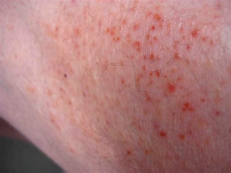 Male age 61 in good health I developed a spotty rash over my whole body ...