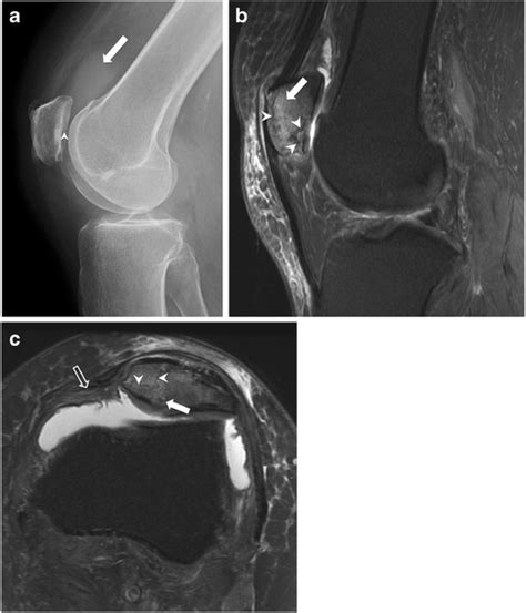 Imaging of patellar fractures | Insights into Imaging | Full Text