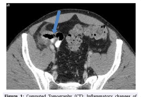 Figure 1 from Yersinia - A Rarer Cause of Terminal Ileitis | Semantic Scholar