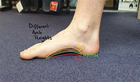 Flat feet vs arched feet - Know the differences & How to treat them