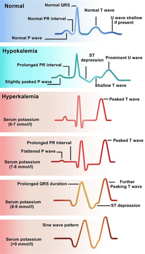 ECG frequency changes in potassium disorders: a narrative review ...