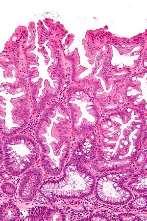 Sessile serrated adenoma - Libre Pathology