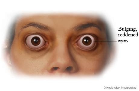 Proptosis / Exophthalmos - Nurses Revision