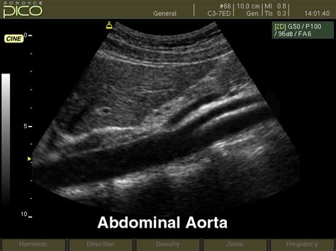 Abdominal Aorta Ultrasound