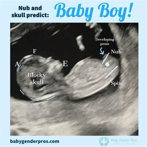 12 Week Ultrasound Girl Vs Boy