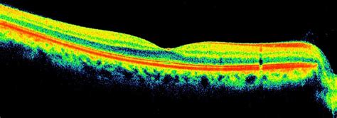 Normal Retina Oct