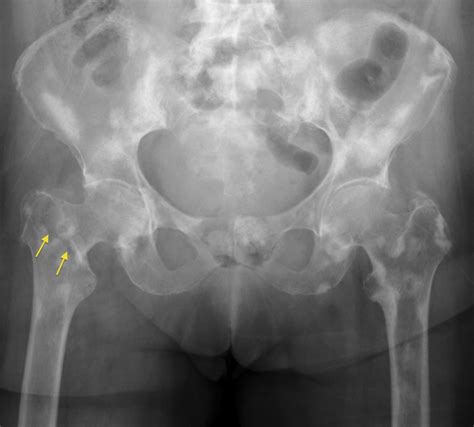 Sclerotic Bone Metastases - Radiology at St. Vincent's University Hospital