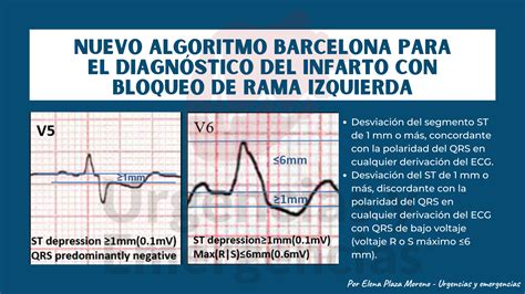 Algoritmo Barcelona: diagnóstico de IAM con bloqueo de rama izq