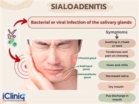 Swollen Salivary Glands Under Chin