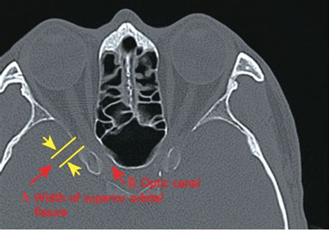 Superior Orbital Fissure Radiology