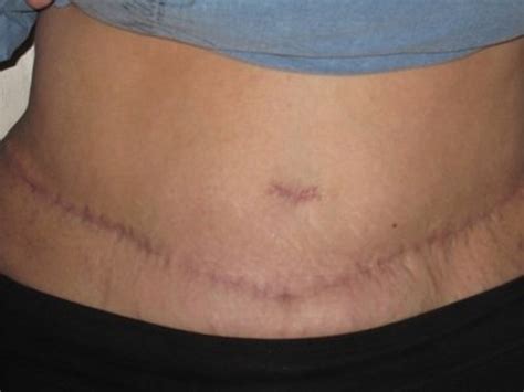 Eleven-month update after bilateral mastectomy and TRAM Flap reconstruction | HubPages