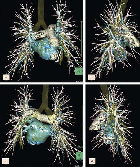 6 Pulmonary Artery and Vein | Radiology Key